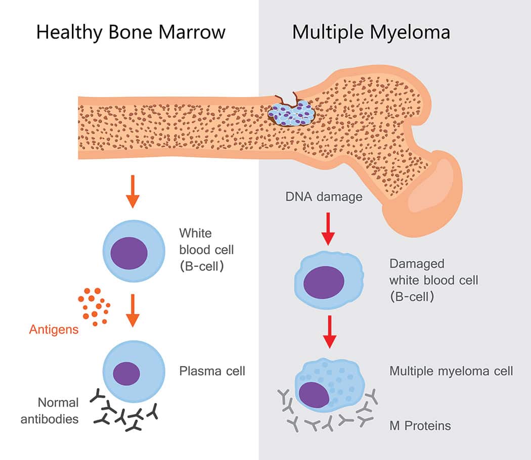 What is Multiple Myeloma? A Guide for Patients and Care Partners